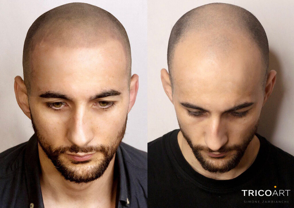 Tricopigmentazione: rimedio per alopecia e calvizia