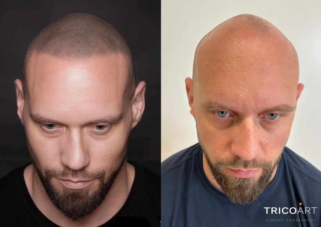Tricopigmentazione: rimedio per alopecia e calvizia